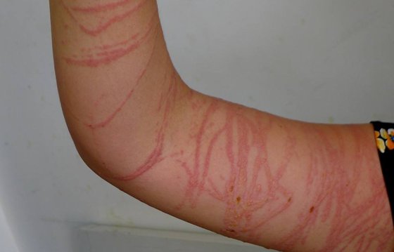 為什么海蜇會蟄人